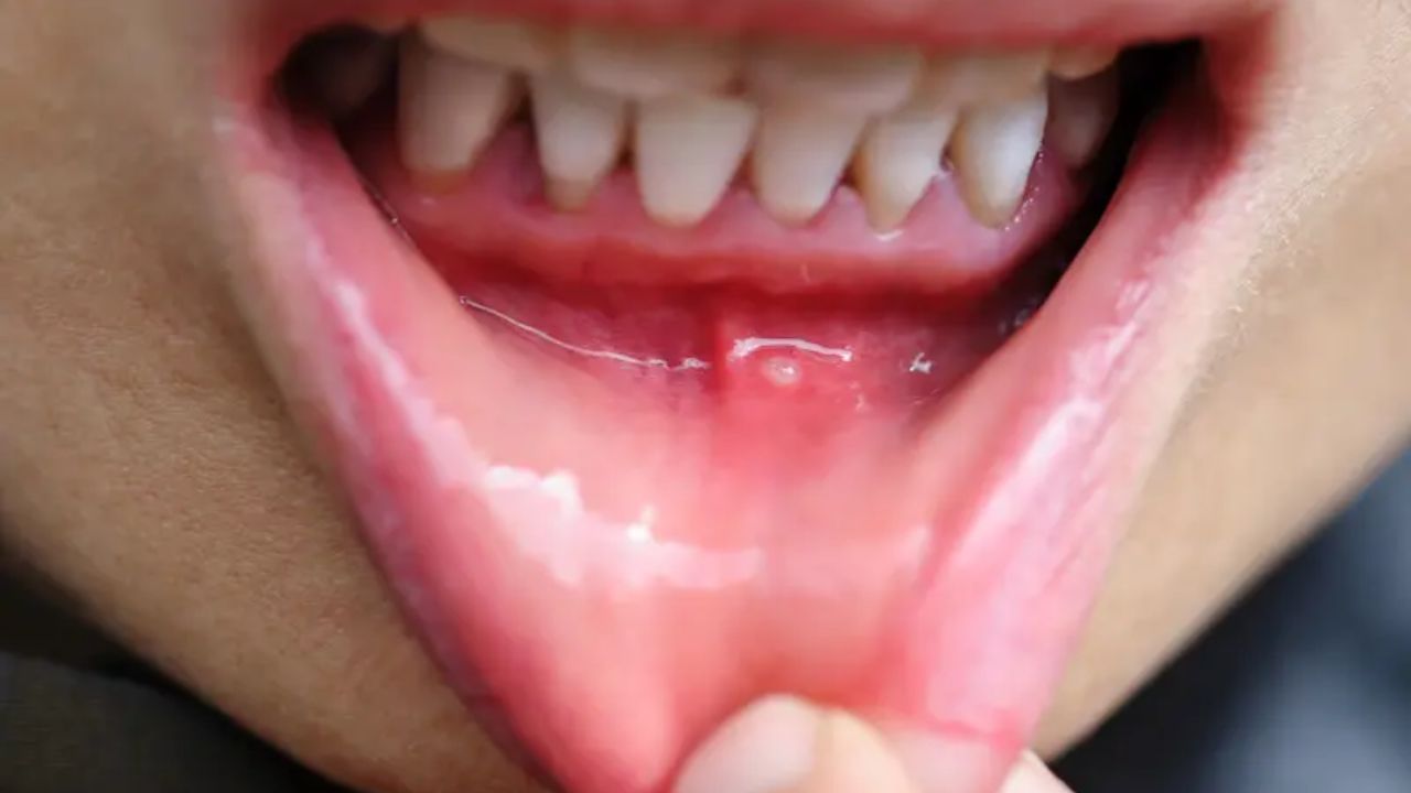 Mouth Ulcers