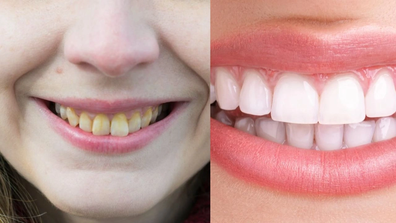 Home Remedies for Yellow Teeth