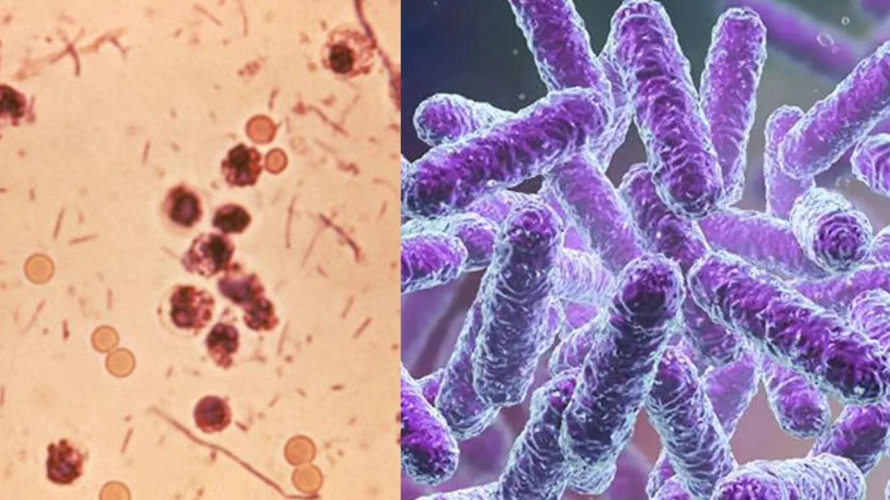 shigella infection
